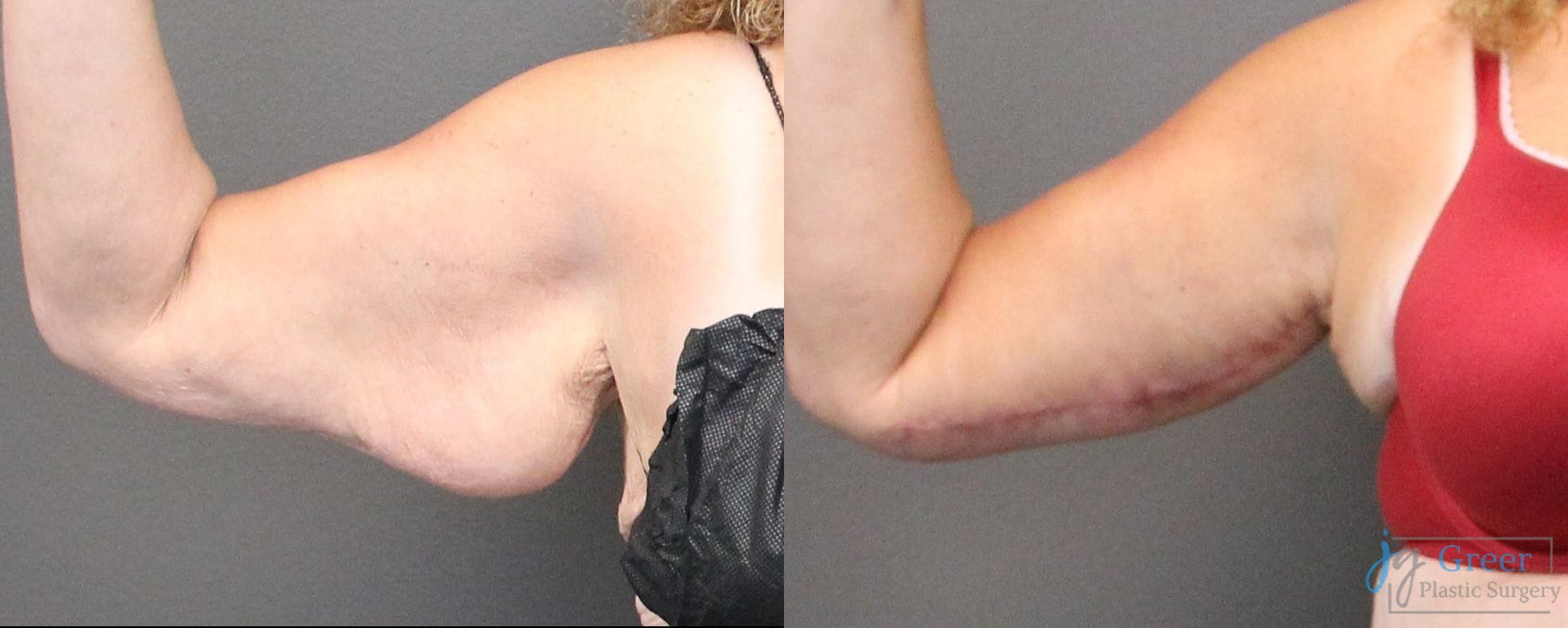 Before and after Brachioplasty case 19857 - Angle 2