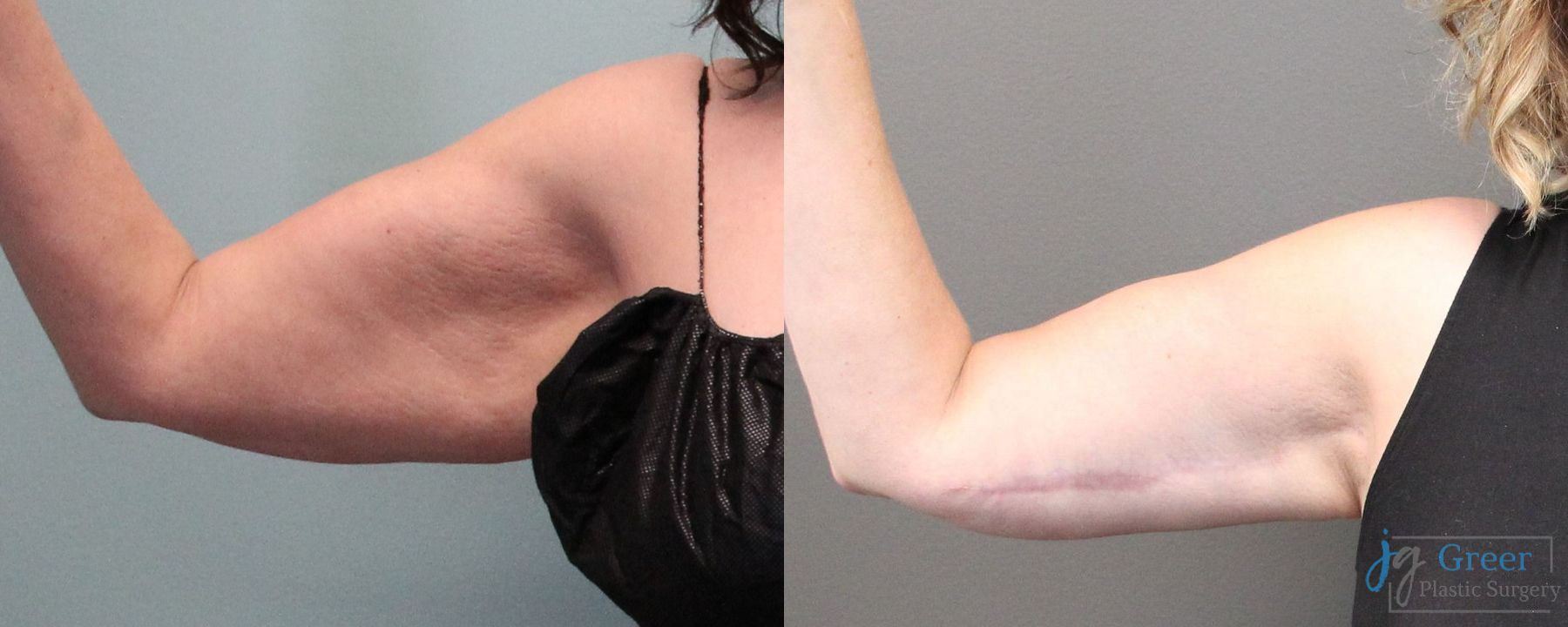 Before and after Brachioplasty case 19860