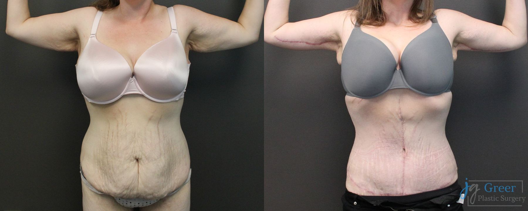 Before and after Fleur-de-Lis Abdominoplasty case 19851