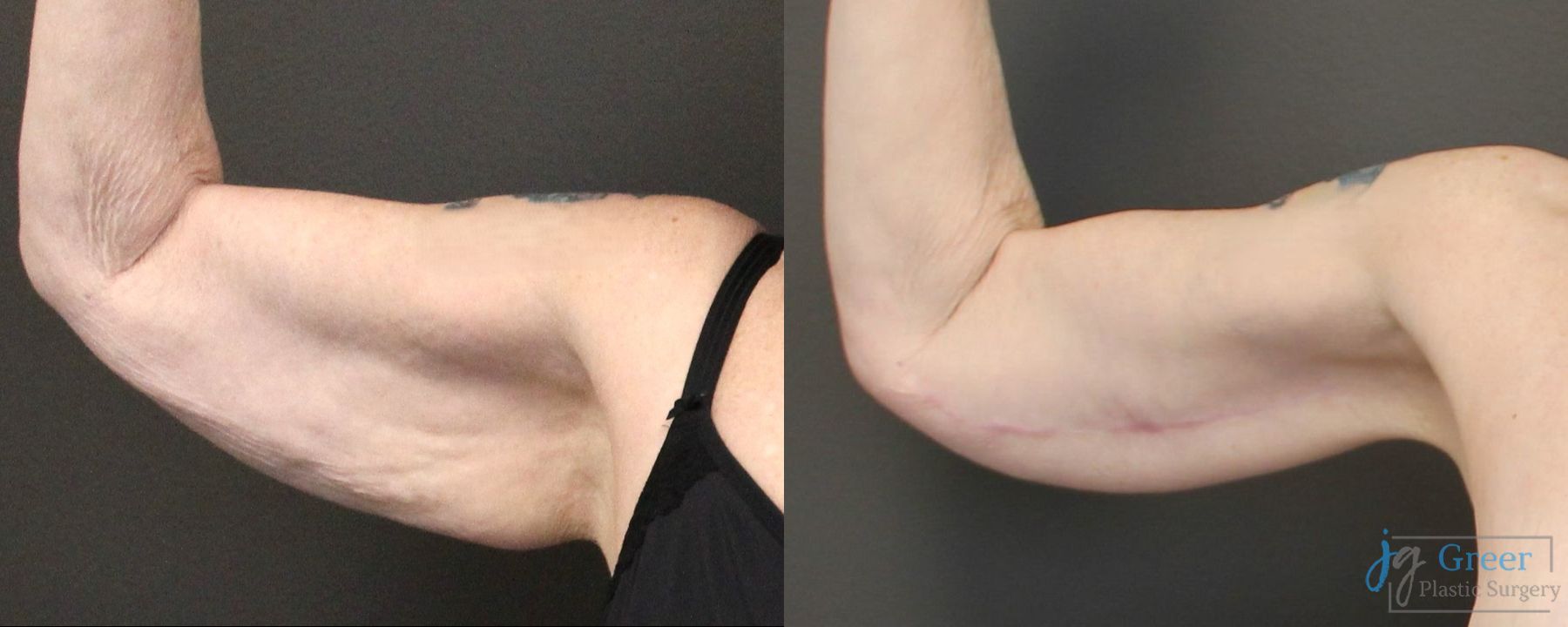 Before and after Brachioplasty case 19863 - Angle 2