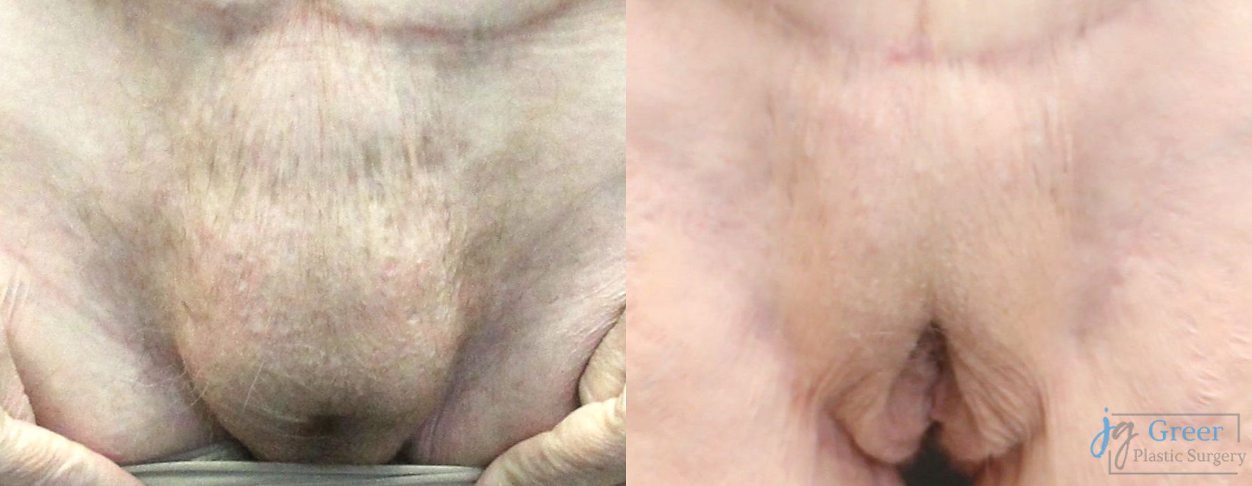 Before and after Thigh Lift case 19863 - Angle 5