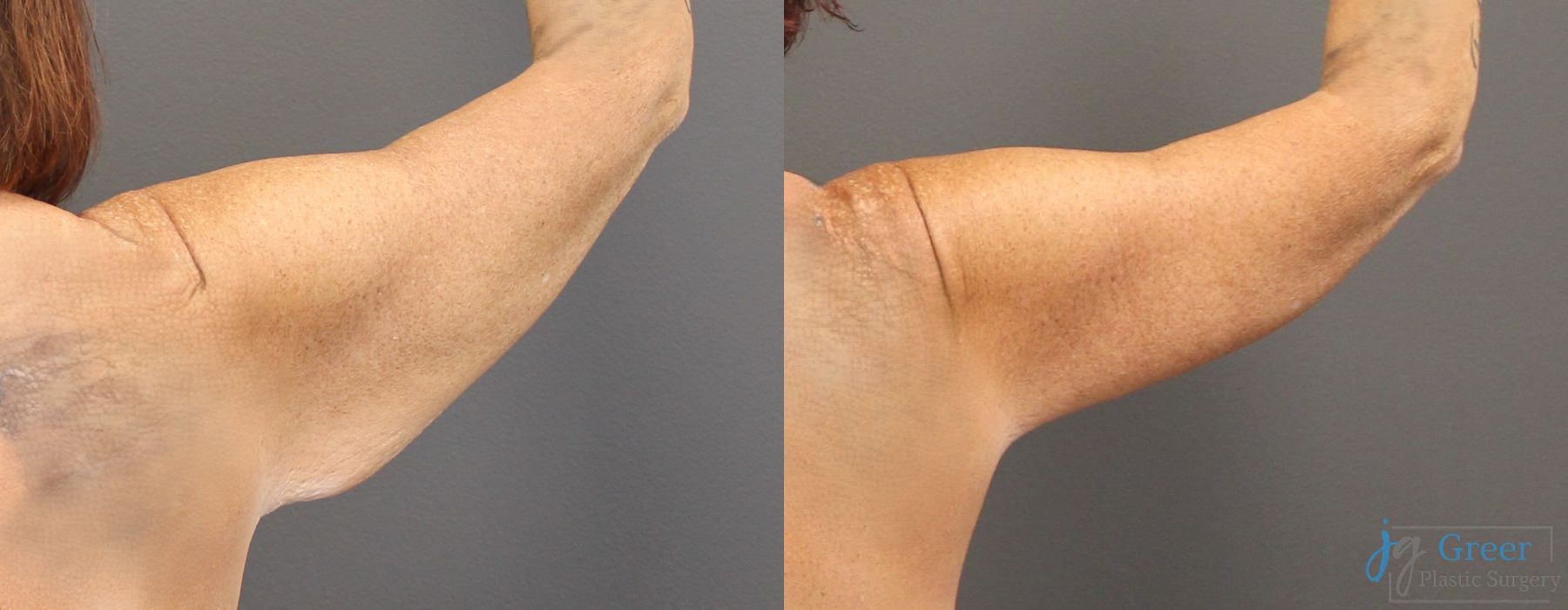 Before photo - Angle 3