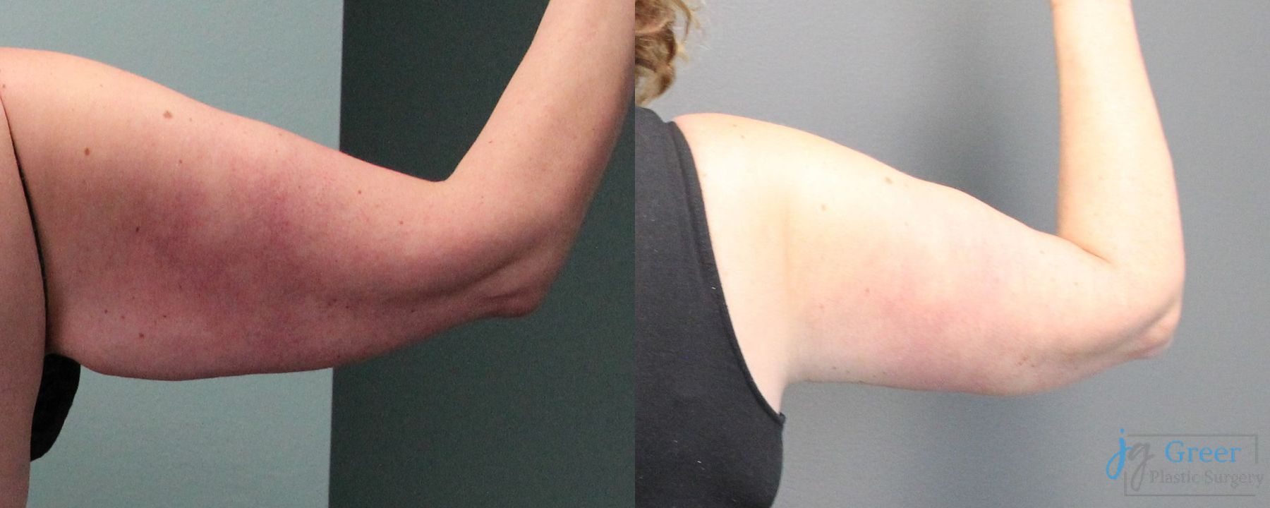 Before and after Brachioplasty case 19860 - Angle 2