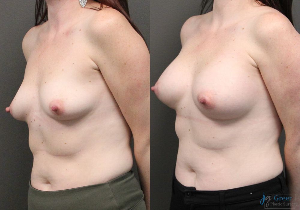 Breast Augmentation - Thumbnail 3