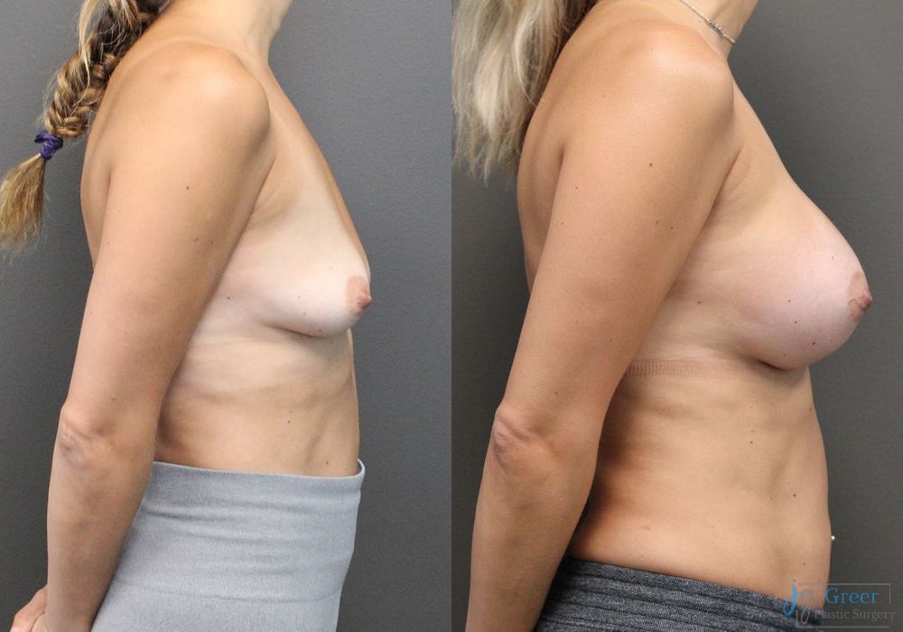Breast Augmentation - Thumbnail 2