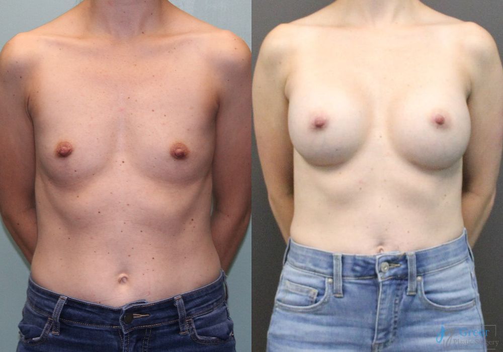 Breast Augmentation - Case 2362