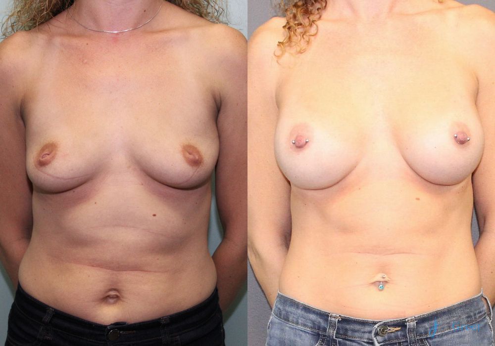 Breast Augmentation - Case 2363