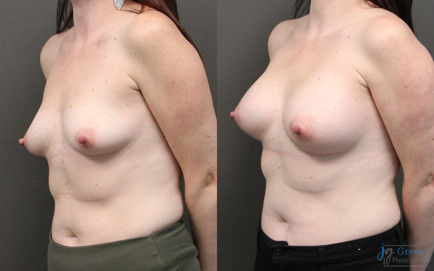 Before and after Breast Augmentation case 19833 - Angle 3