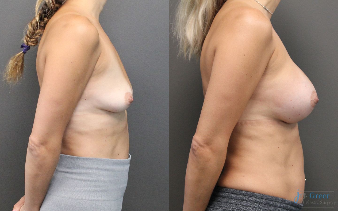 Before and after Breast Augmentation case 19832 - Angle 2