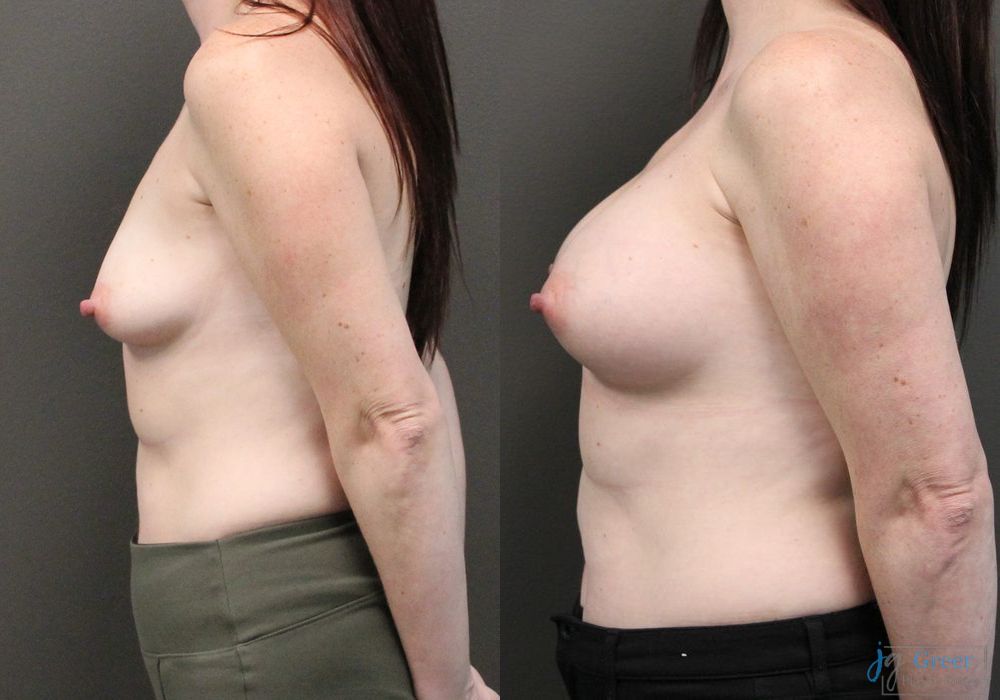 Breast Augmentation - Thumbnail 2