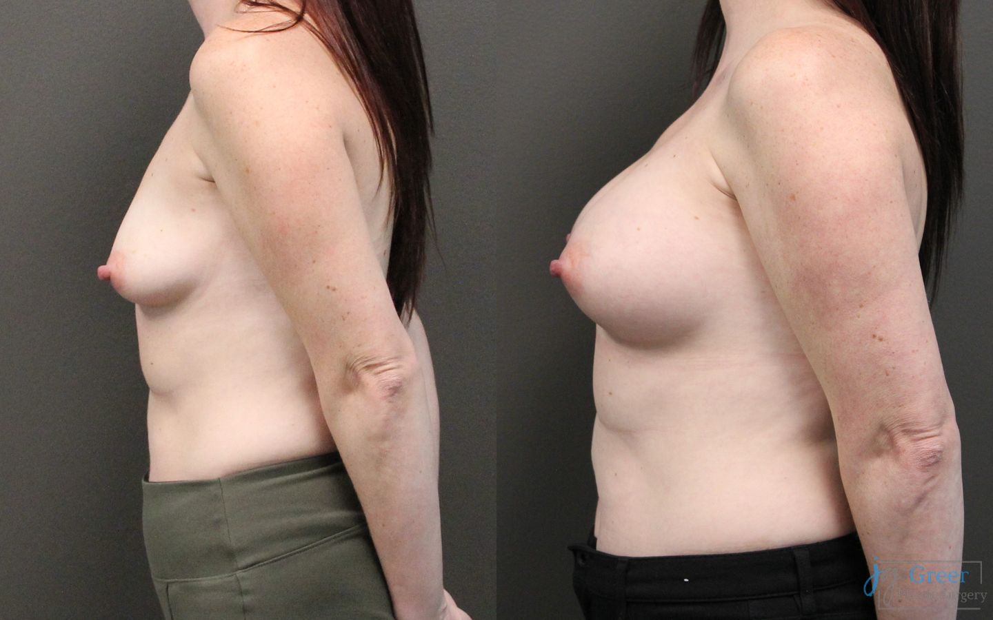 Before and after Breast Augmentation case 19833 - Angle 2
