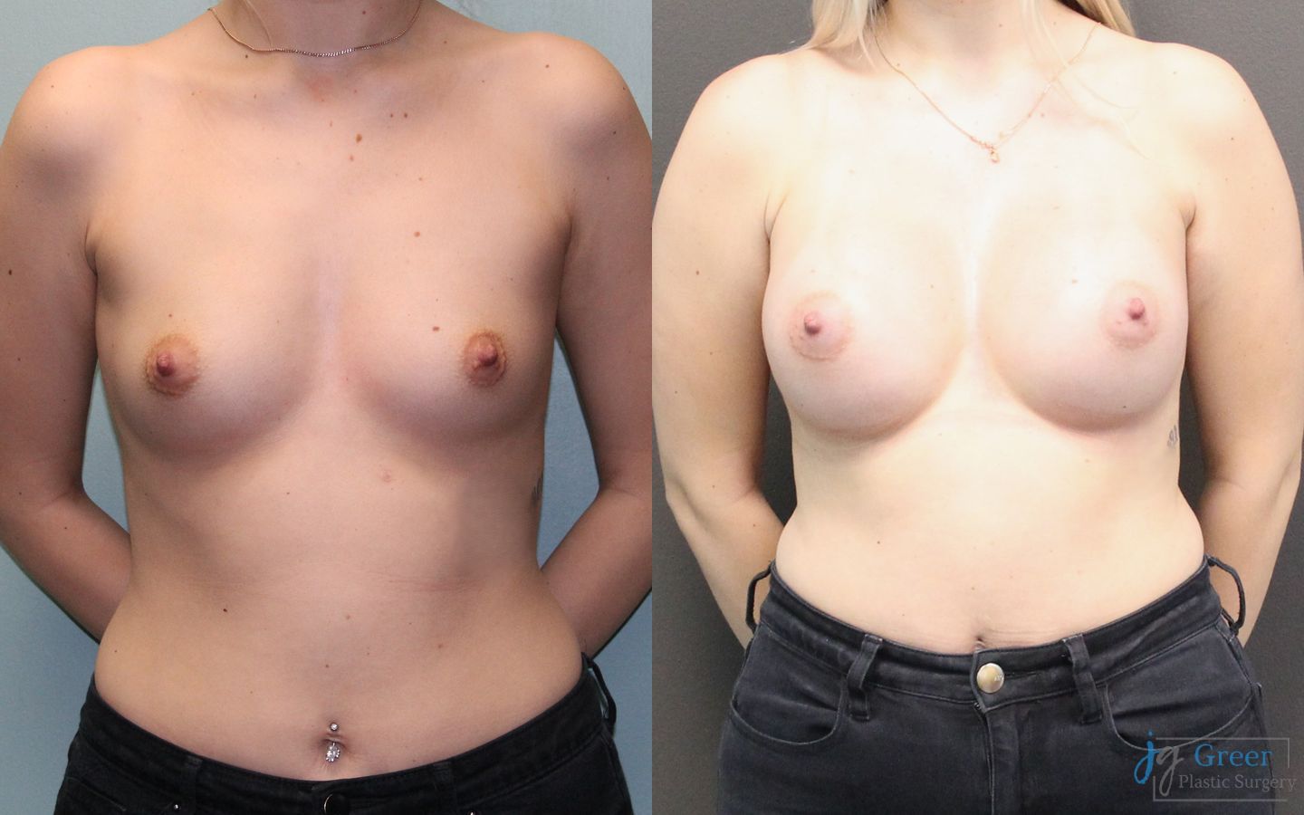 Before and after Breast Augmentation case 19834