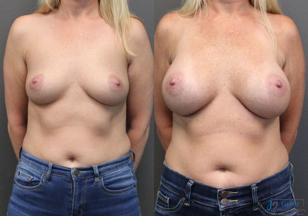 Breast Augmentation - Case 2364