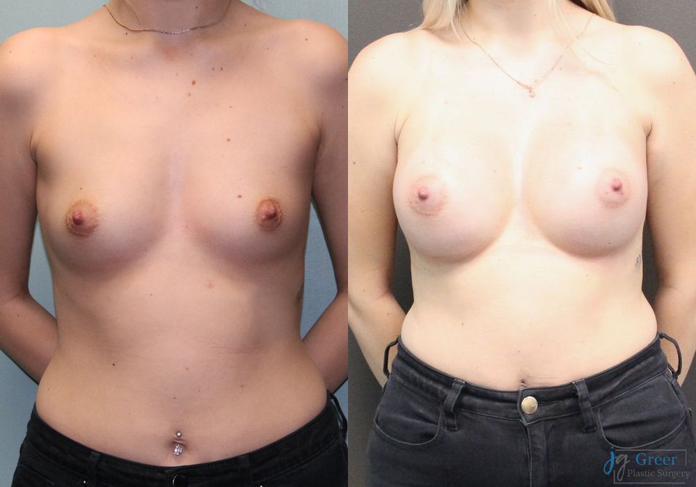 Breast Augmentation - Case 2361
