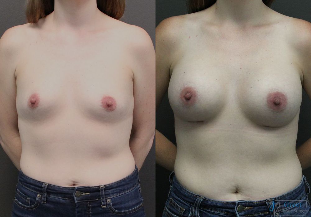 Breast Augmentation - Case 2355