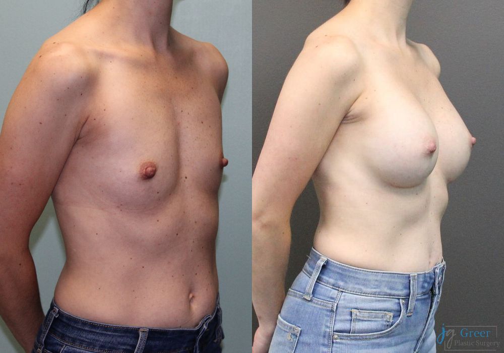 Breast Augmentation - Thumbnail 3