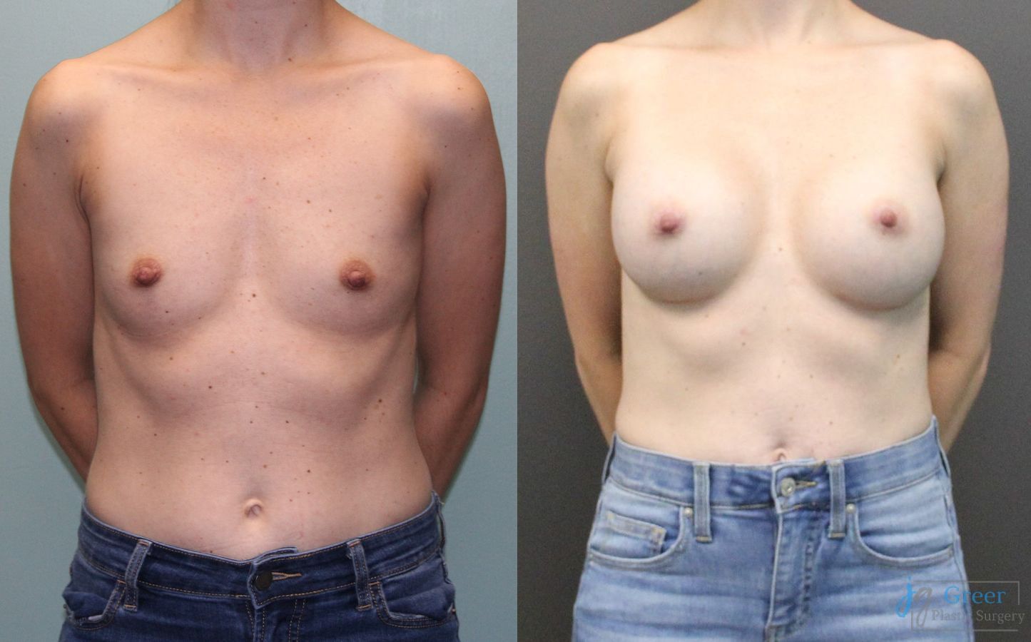 Before and after Breast Augmentation case 19835
