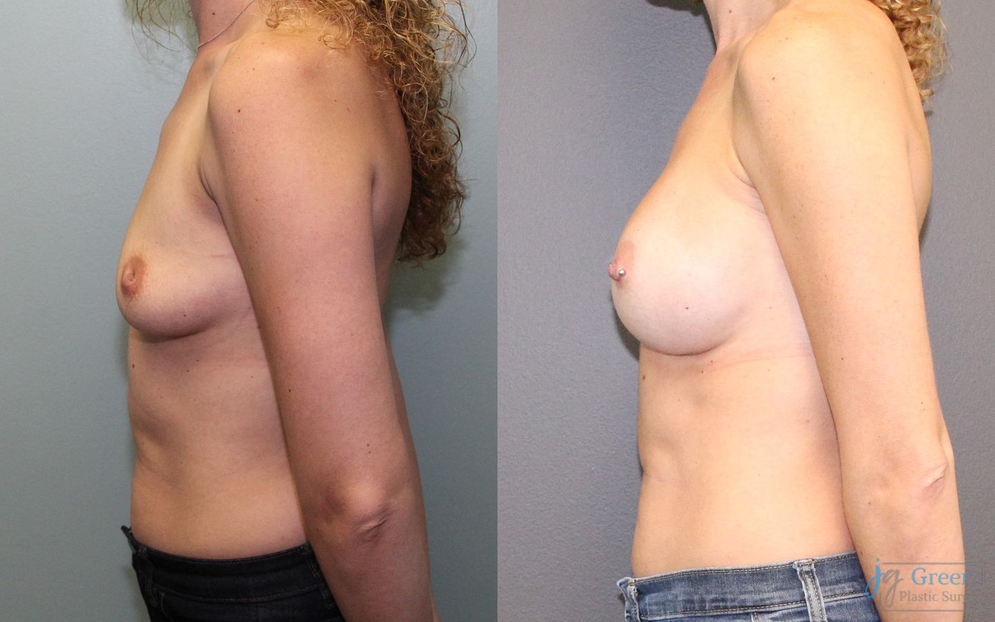 Before and after Breast Augmentation case 19836 - Angle 2