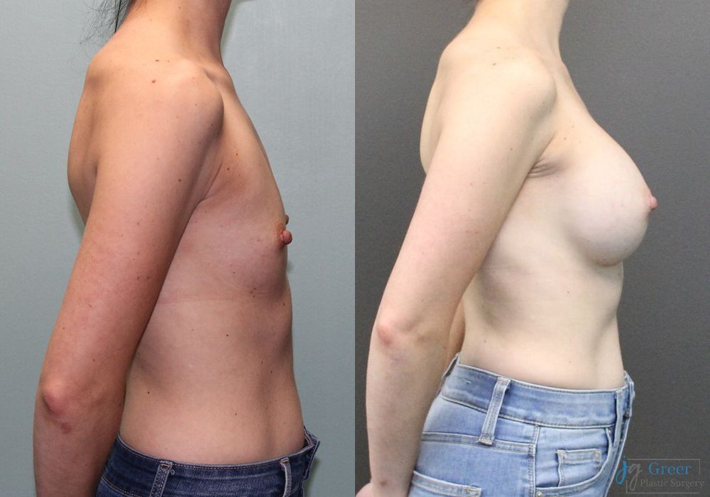 Breast Augmentation - Thumbnail 2