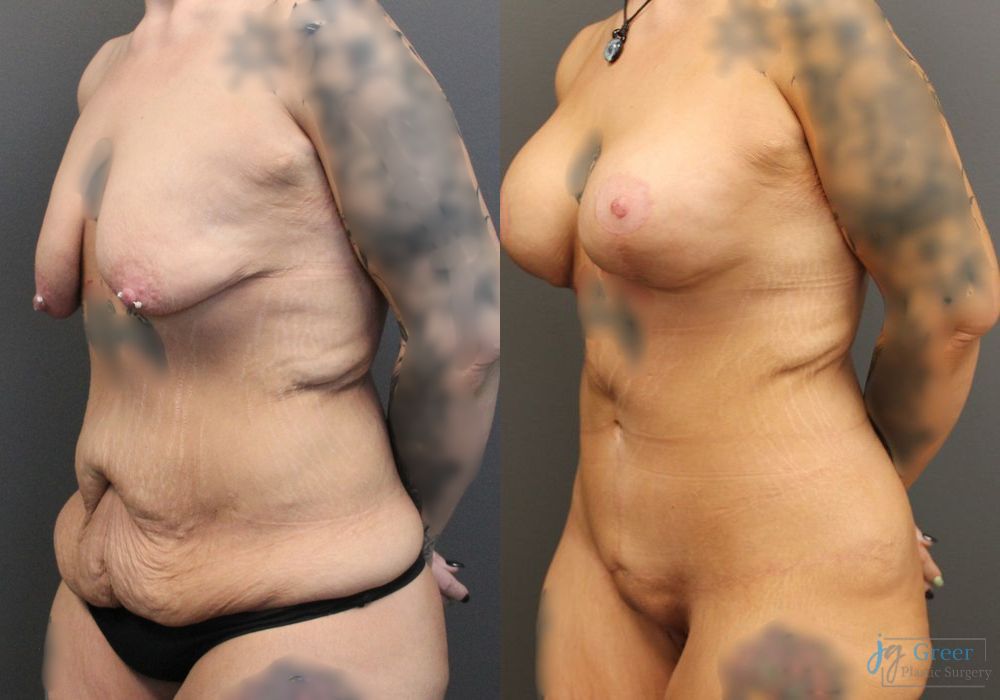 Before and after Breast Augmentation case 19852 - Angle 2
