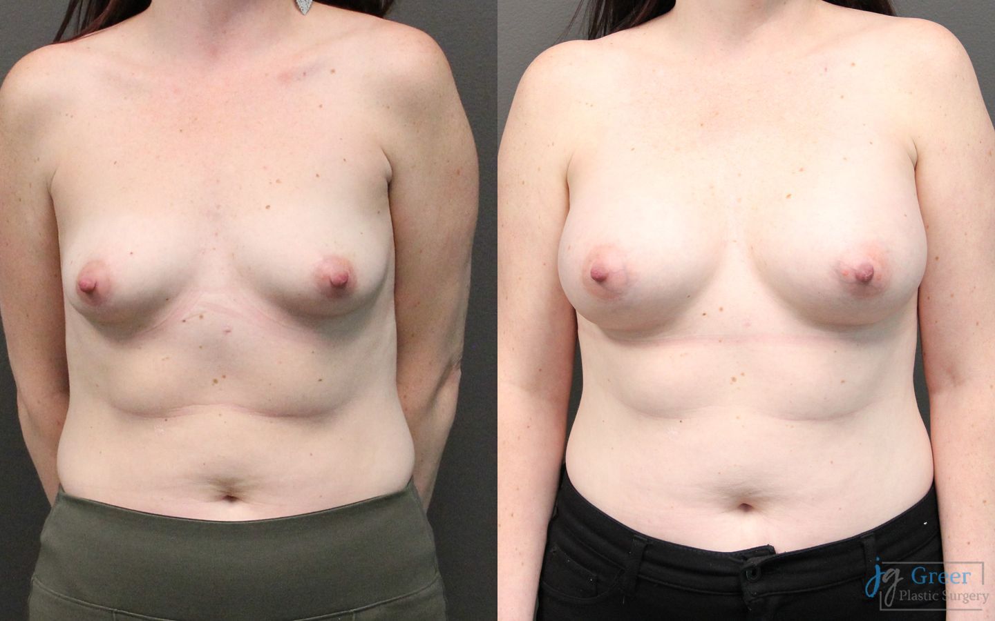 Before and after Breast Augmentation case 19833