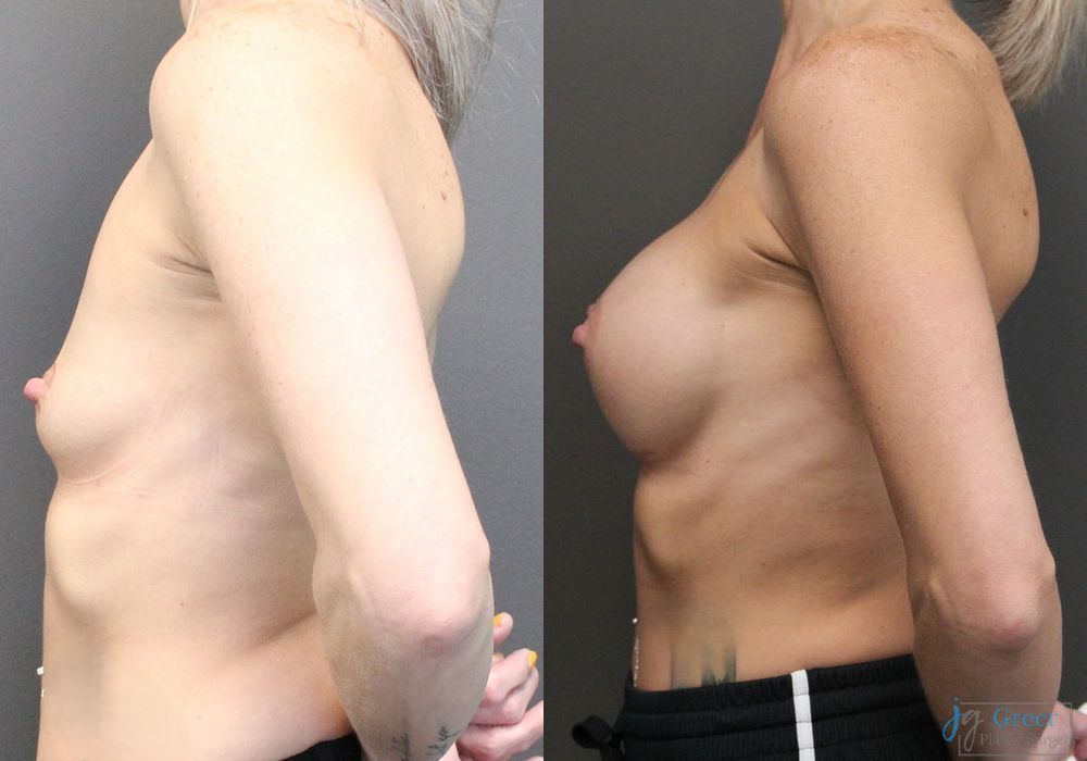 Breast Augmentation - Thumbnail 2