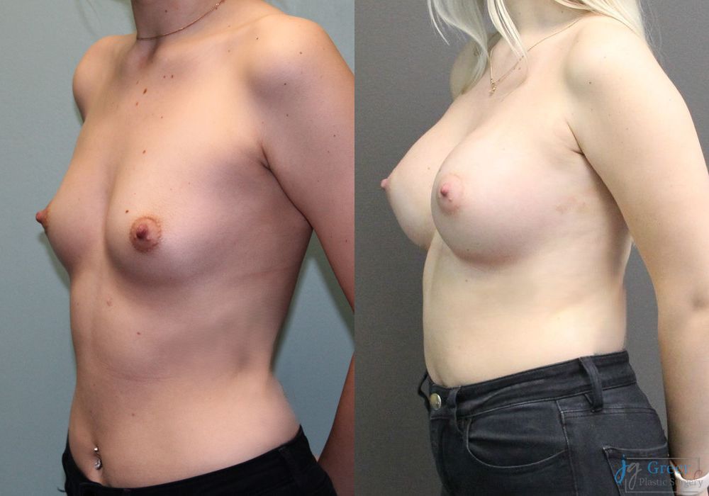 Breast Augmentation - Thumbnail 3