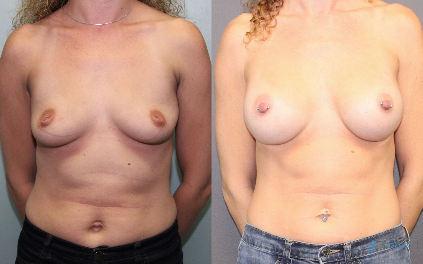 Before and after Breast Augmentation case 19836