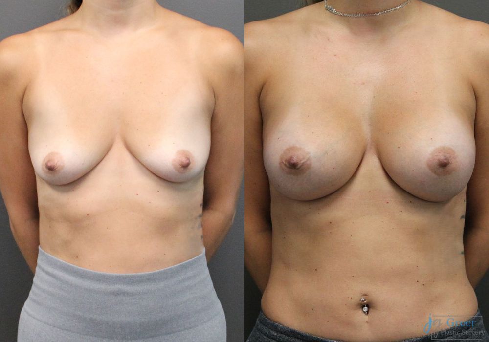 Breast Augmentation - Case 2359