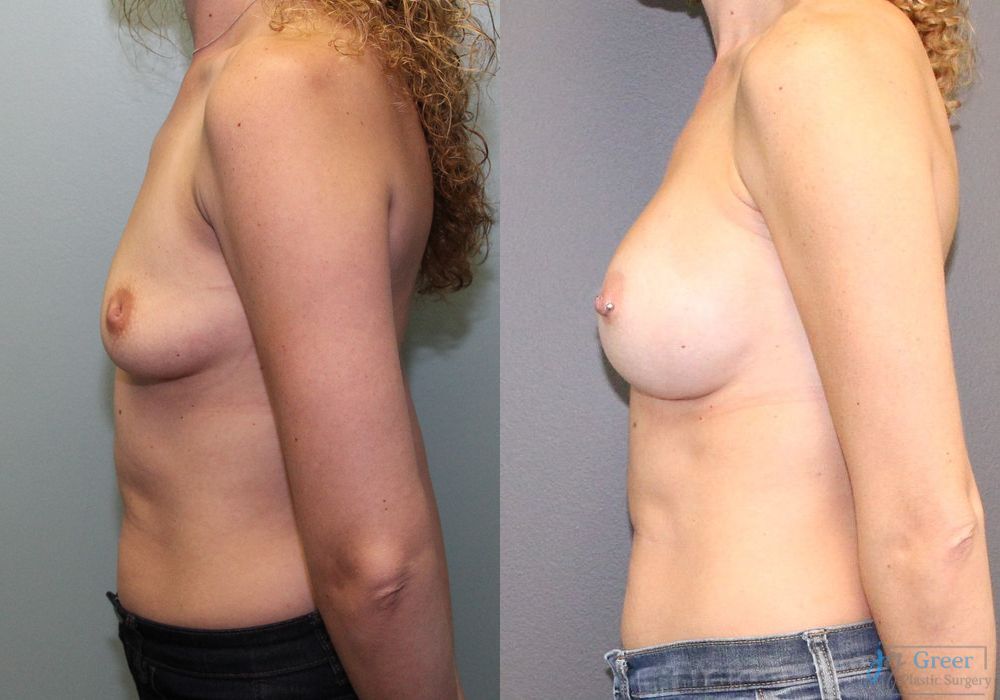 Breast Augmentation - Thumbnail 2