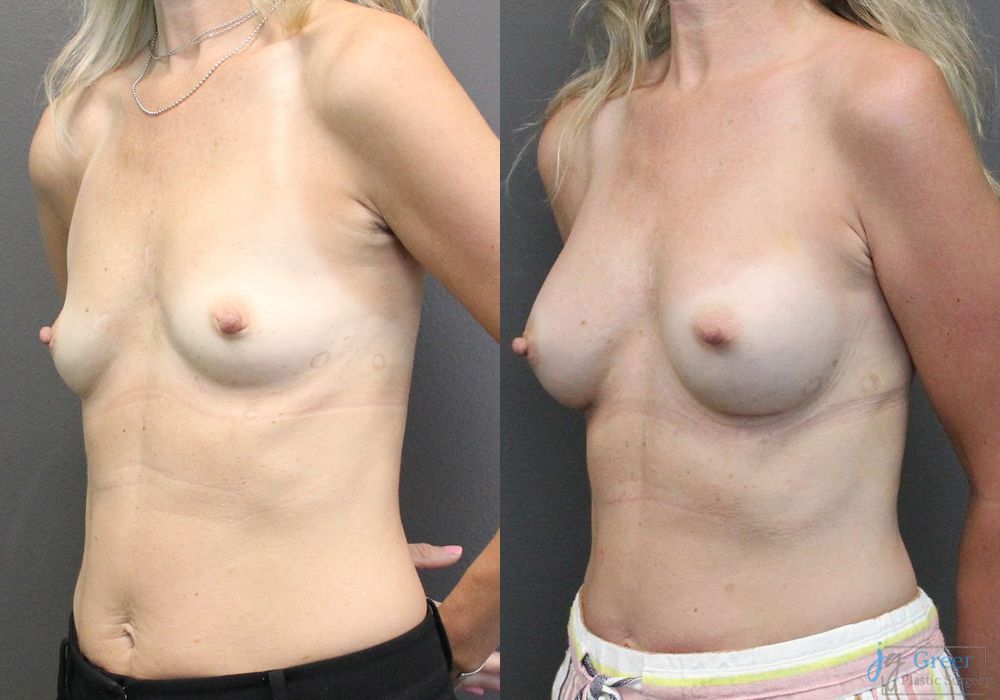 Breast Augmentation - Thumbnail 3