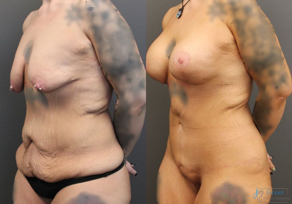 Breast Augmentation - Thumbnail 2