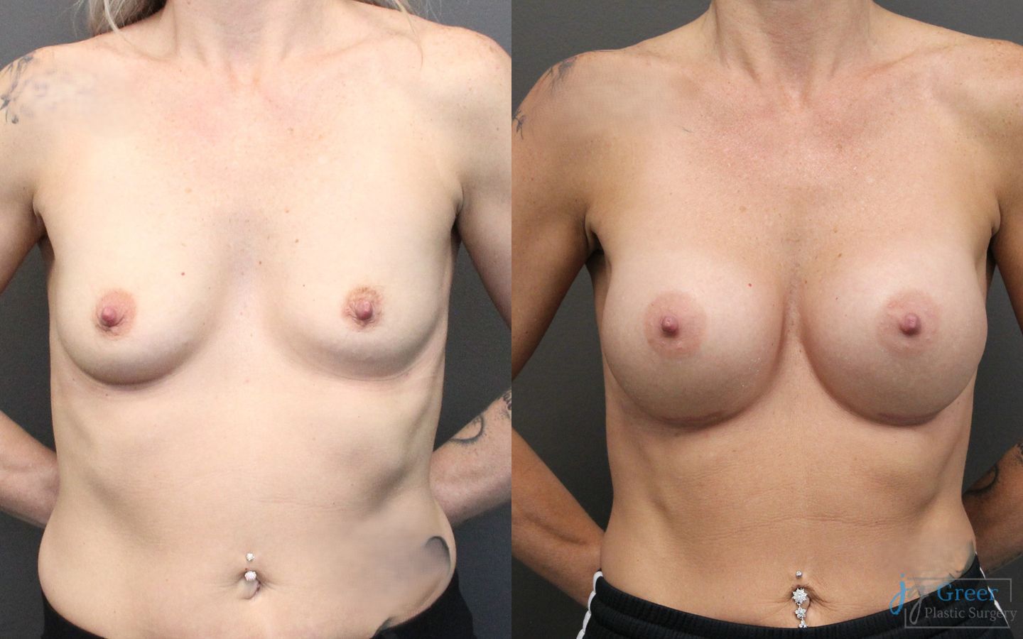 Before and after Breast Augmentation case 19829