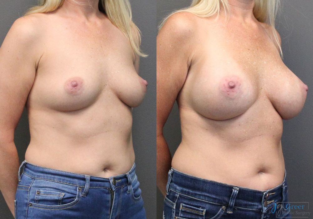 Breast Augmentation - Thumbnail 3