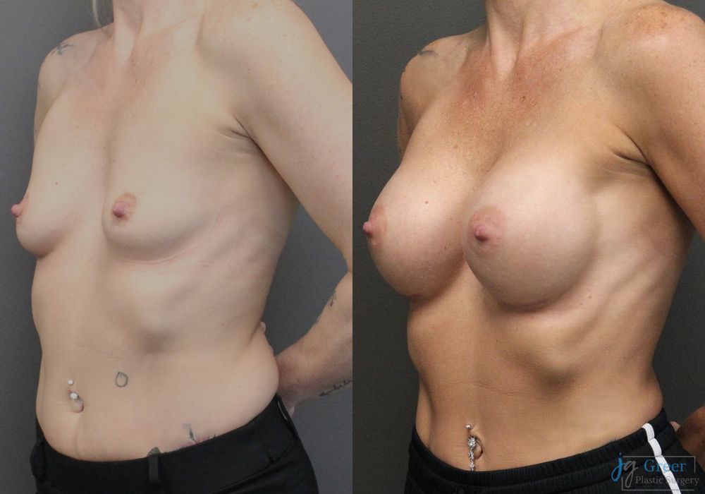 Breast Augmentation - Thumbnail 3