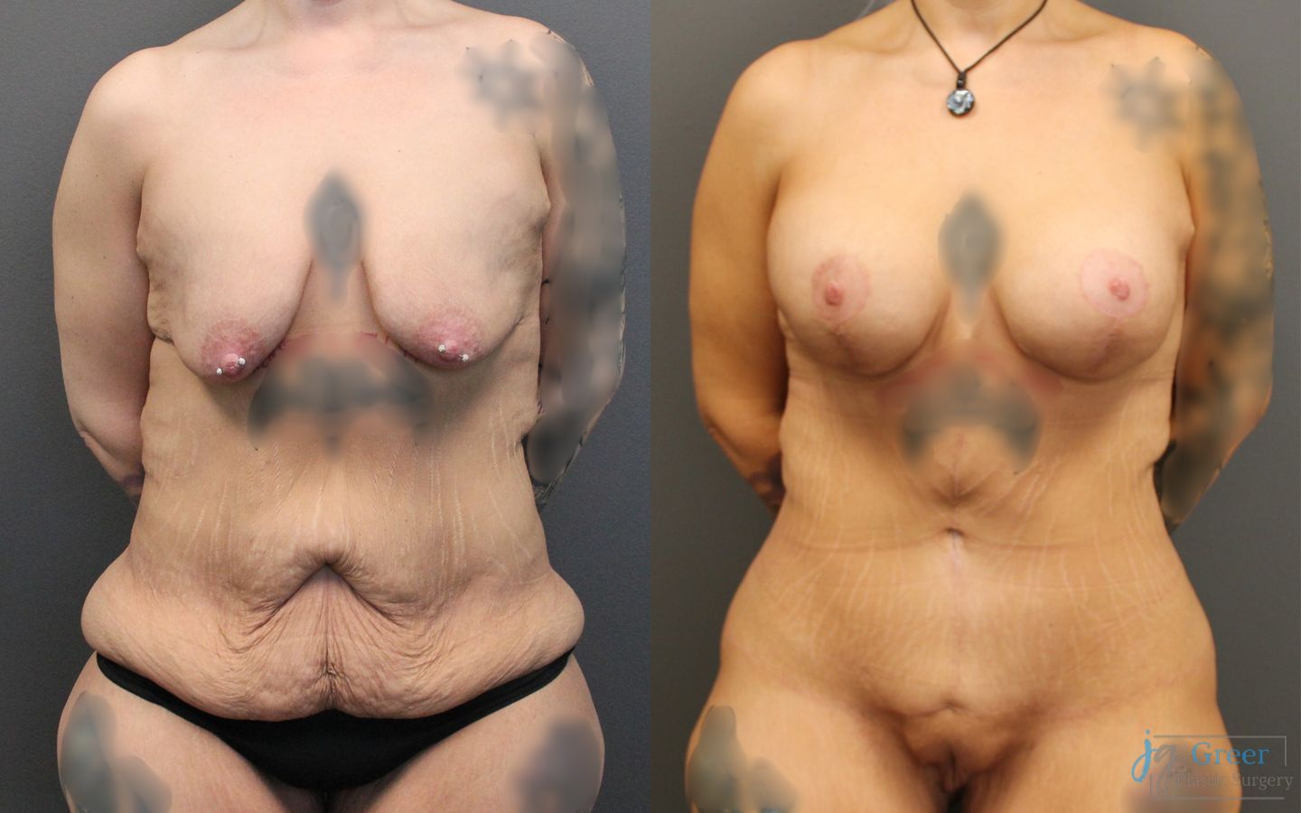 Before and after Fleur-de-Lis Abdominoplasty case 19852