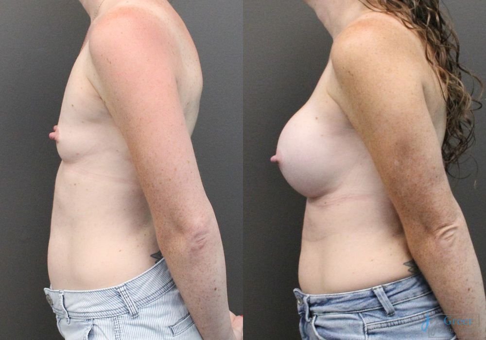 Breast Augmentation - Thumbnail 2