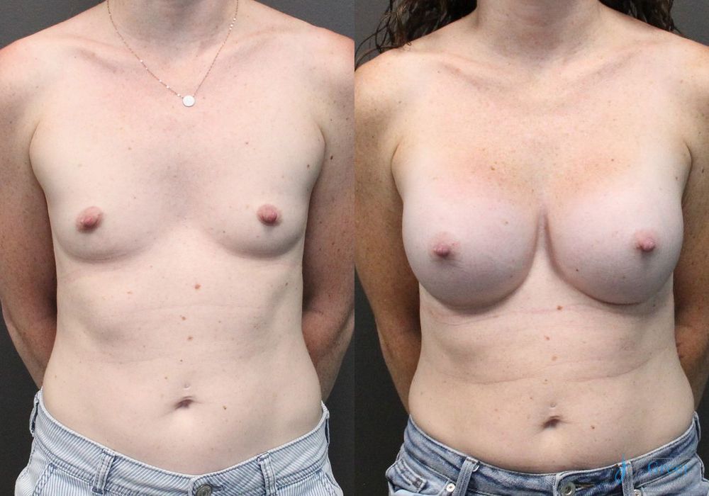 Breast Augmentation - Case 2358