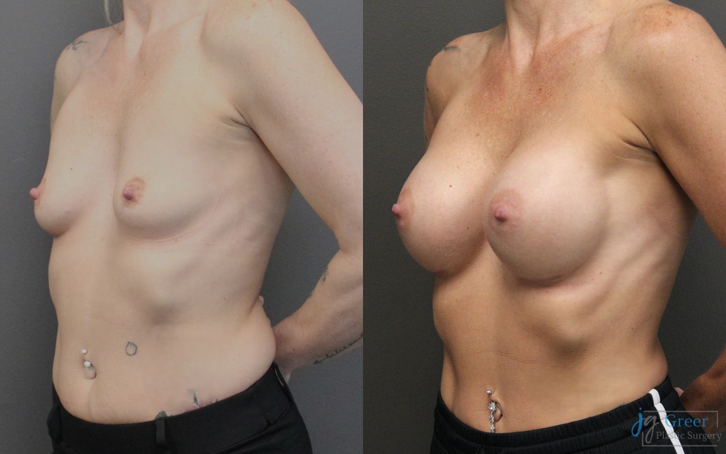Before and after Breast Augmentation case 19829 - Angle 3