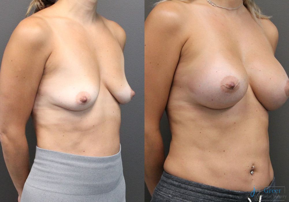 Breast Augmentation - Thumbnail 3