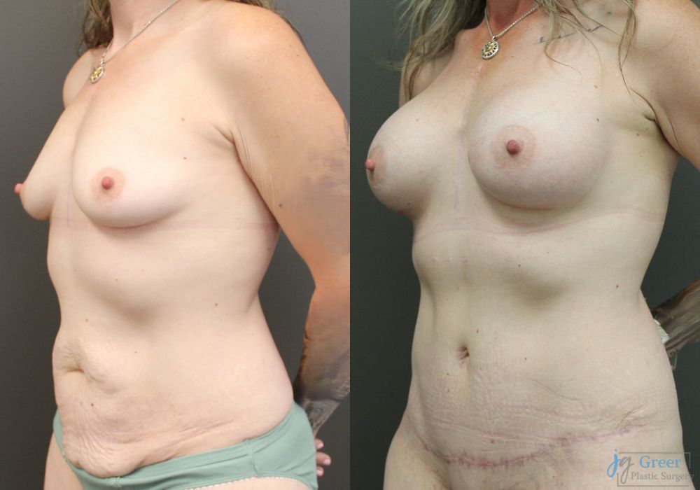 Breast Augmentation - Case 2387