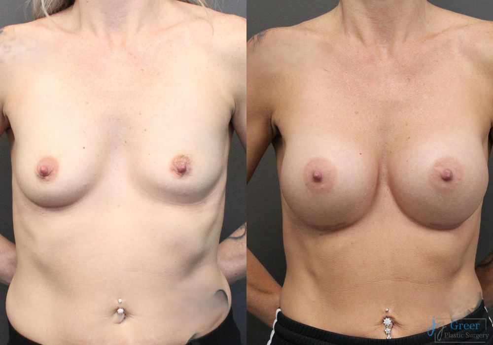 Breast Augmentation - Case 2356