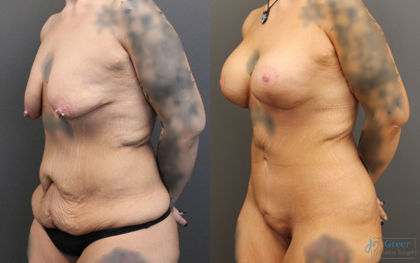 Before and after Fleur-de-Lis Abdominoplasty case 19852 - Angle 2