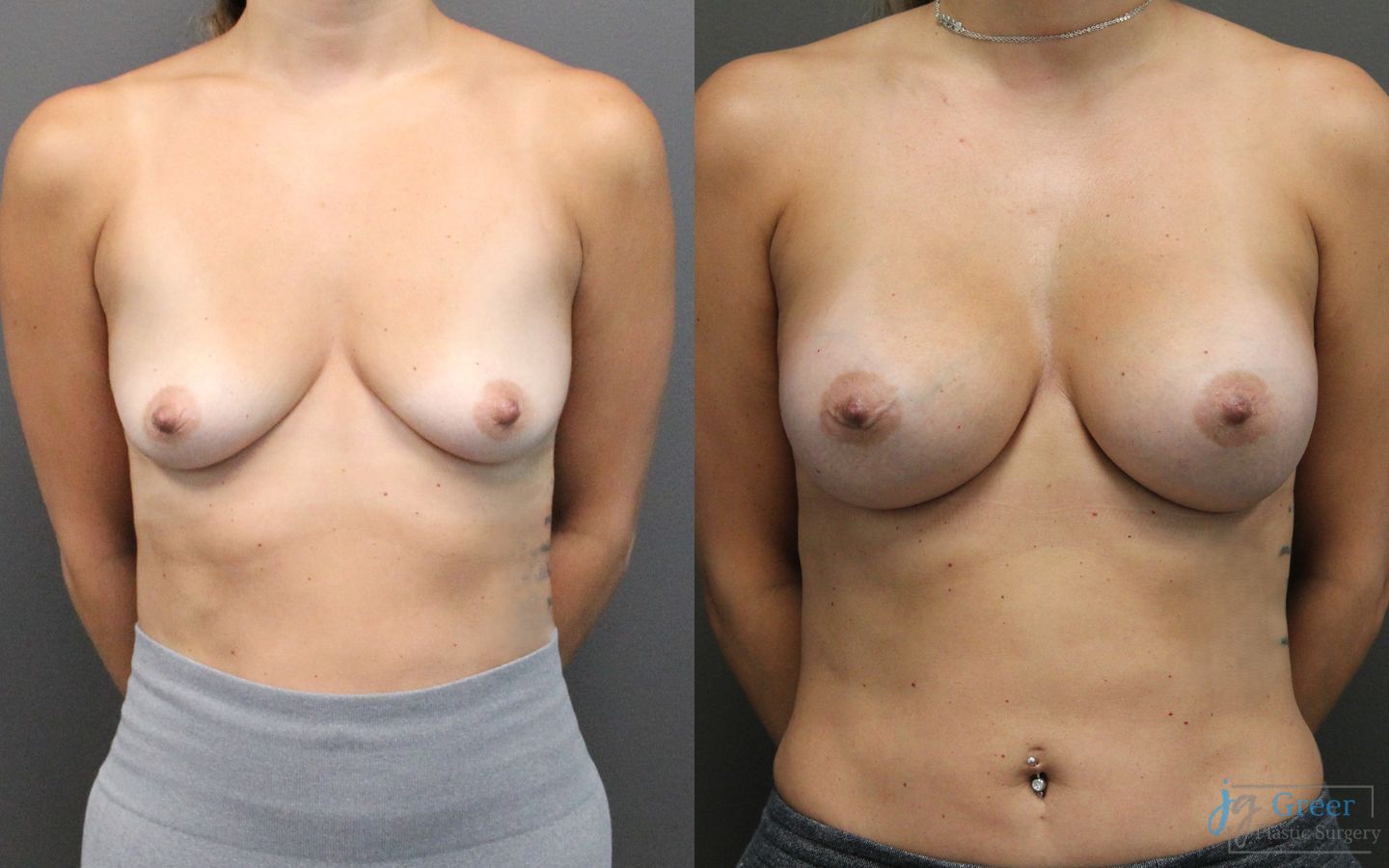 Before and after Breast Augmentation case 19832
