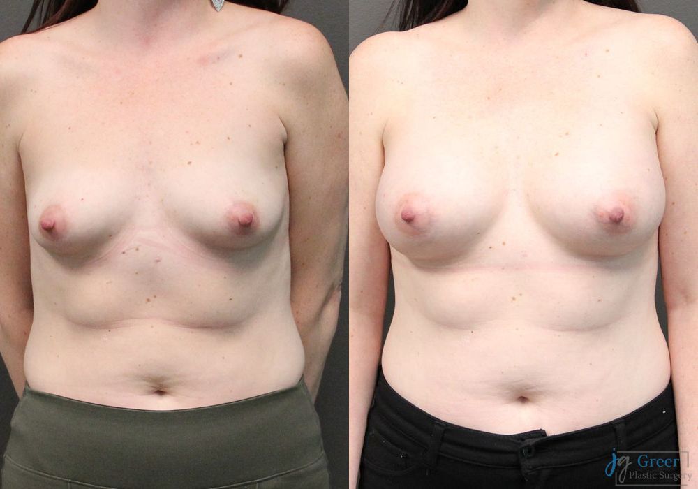 Breast Augmentation - Case 2360