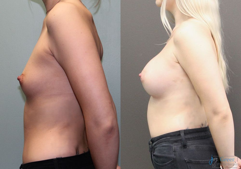 Breast Augmentation - Thumbnail 2