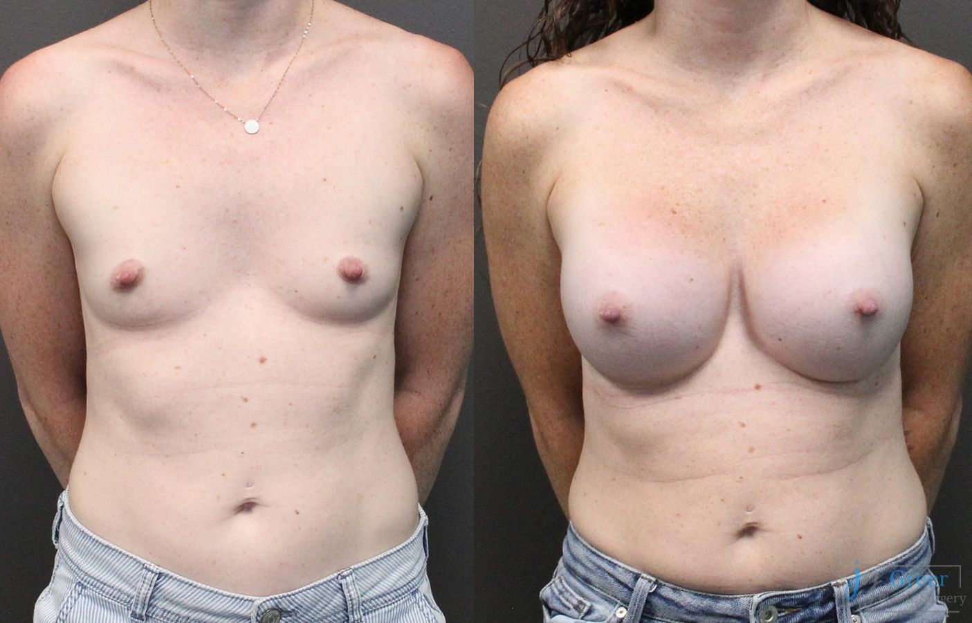 Before and after Breast Augmentation case 19831