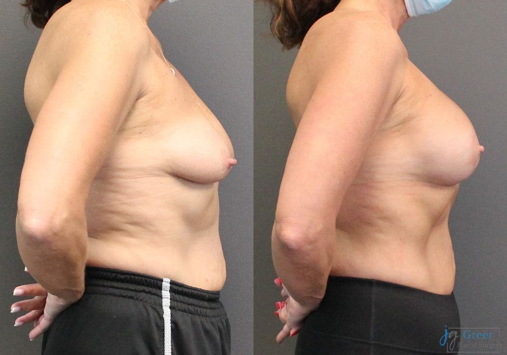 Breast Augmentation with Lift - Thumbnail 2