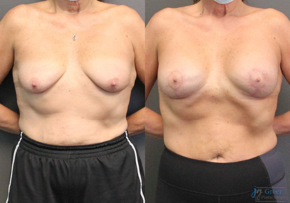 Breast Augmentation with Lift - Case 2367