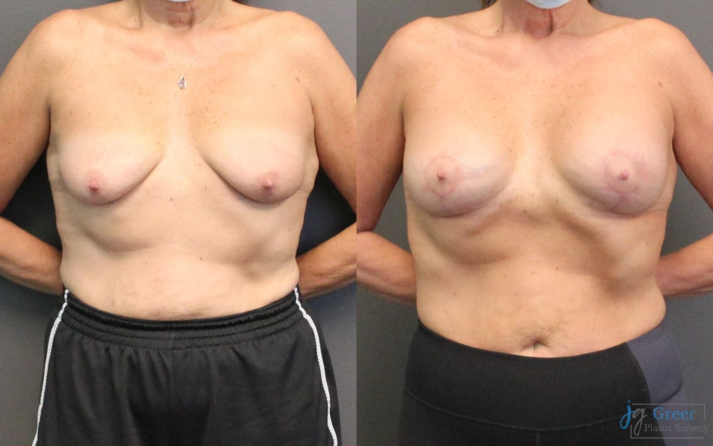 Before and after Breast Augmentation with Lift case 19823